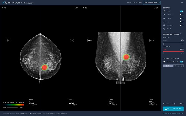 하나로 의료재단, 유방암 판독 AI 솔루션 ‘루닛 인사이트 MMG’ 도입
