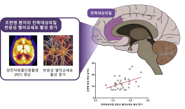 서울대병원, PET 이용해 조현병 증상 및 뇌 속 반응성 별아교세포 증가 연관성 규명